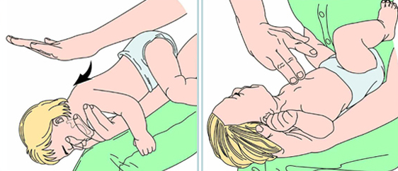 desengasgo em bebês: manobra de hemlich
